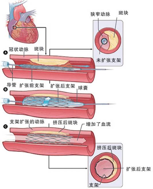 怎樣治療冠心??？(圖2)