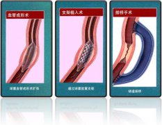 怎樣治療冠心??？